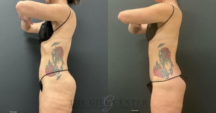 Body Contouring Case 734 Before & After Left Side | The Woodlands, TX | The Gill Center for Plastic Surgery and Dermatology
