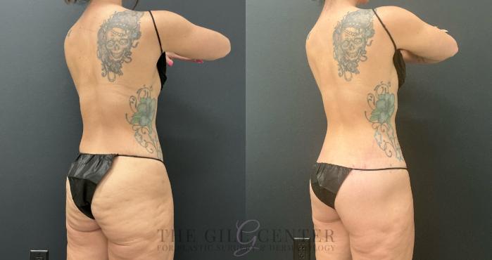 Body Contouring Case 734 Before & After Right Oblique | The Woodlands, TX | The Gill Center for Plastic Surgery and Dermatology