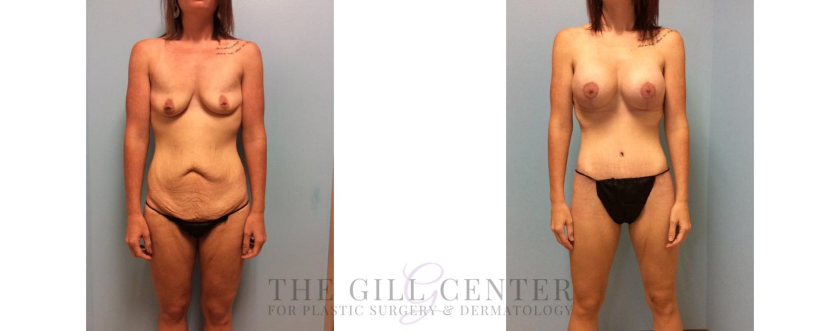 Body Lift Case 334 Before & After Front | The Woodlands, TX | The Gill Center for Plastic Surgery and Dermatology