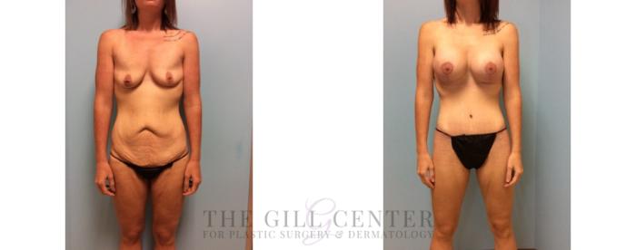Body Lift Case 334 Before & After Front | The Woodlands, TX | The Gill Center for Plastic Surgery and Dermatology