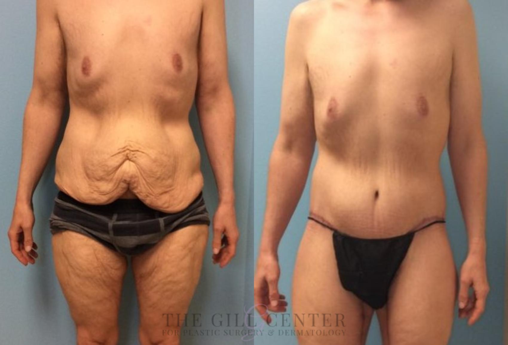 Body Lift Case 336 Before & After Front | The Woodlands, TX | The Gill Center for Plastic Surgery and Dermatology