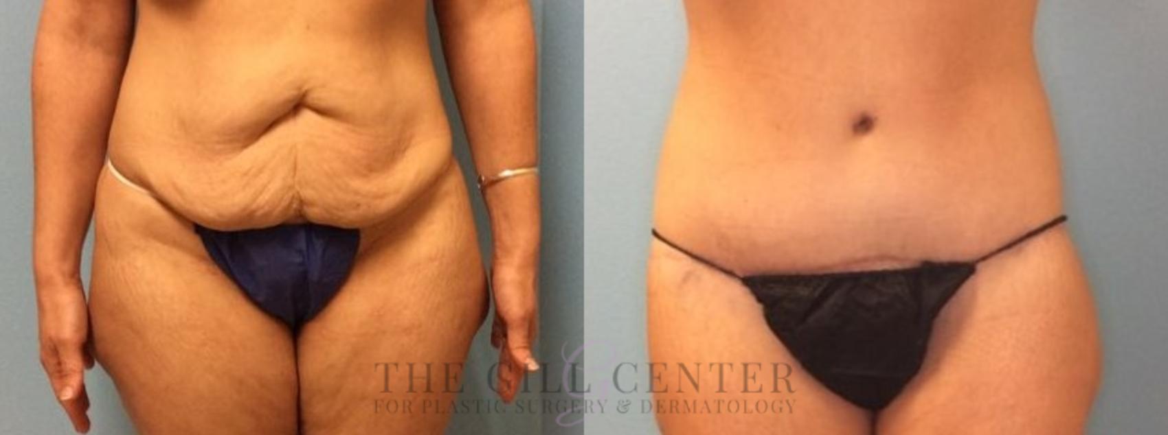 Body Lift Case 337 Before & After Front | The Woodlands, TX | The Gill Center for Plastic Surgery and Dermatology