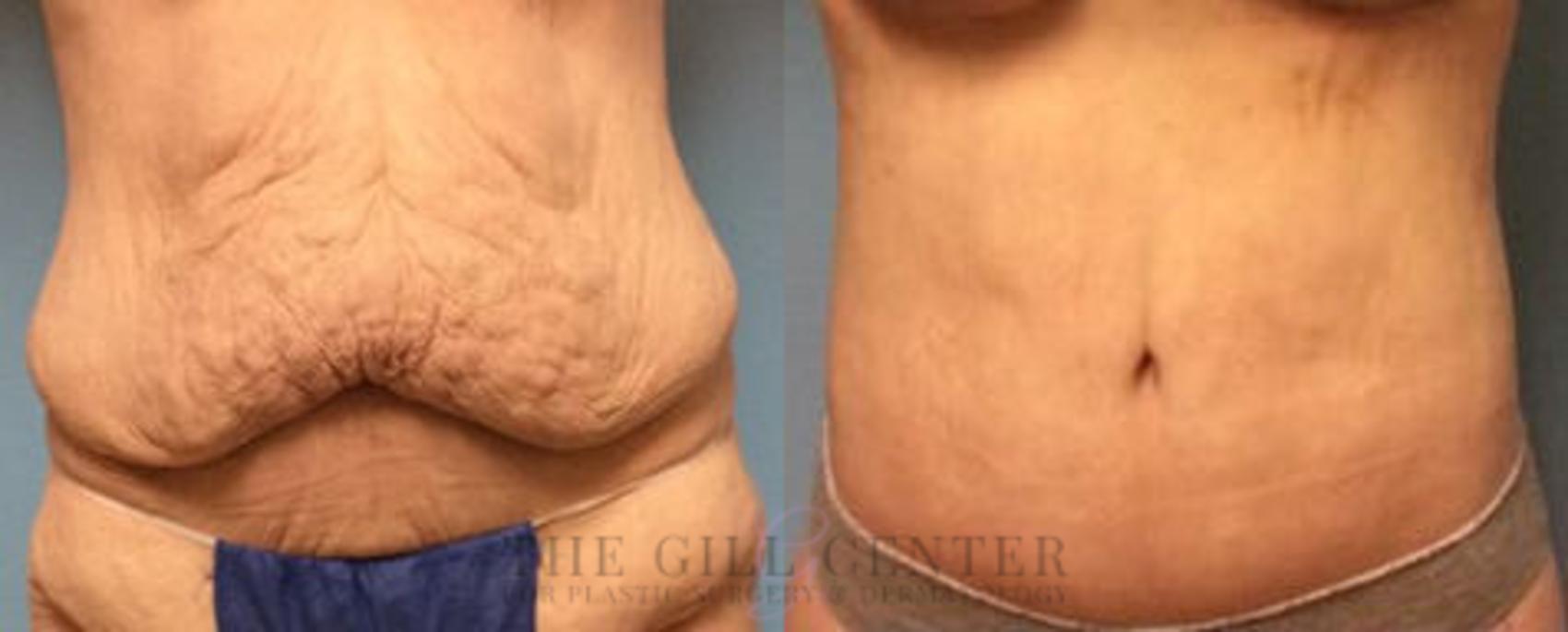 Body Lift Case 338 Before & After Front | The Woodlands, TX | The Gill Center for Plastic Surgery and Dermatology