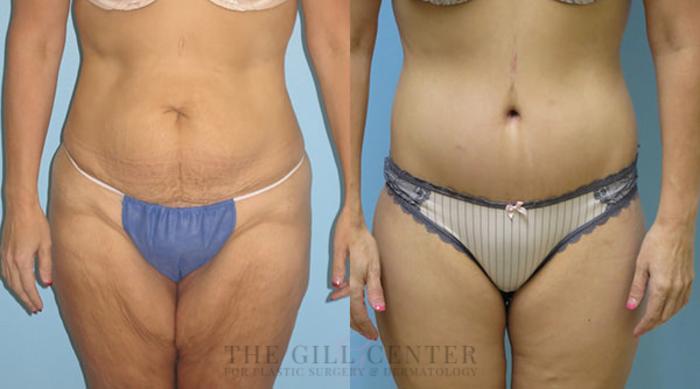 Body Lift Case 341 Before & After Front | The Woodlands, TX | The Gill Center for Plastic Surgery and Dermatology