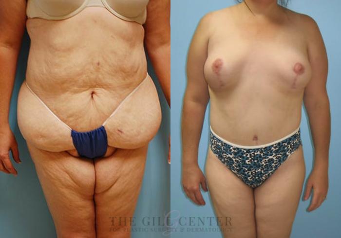 Body Lift Case 342 Before & After Front | The Woodlands, TX | The Gill Center for Plastic Surgery and Dermatology