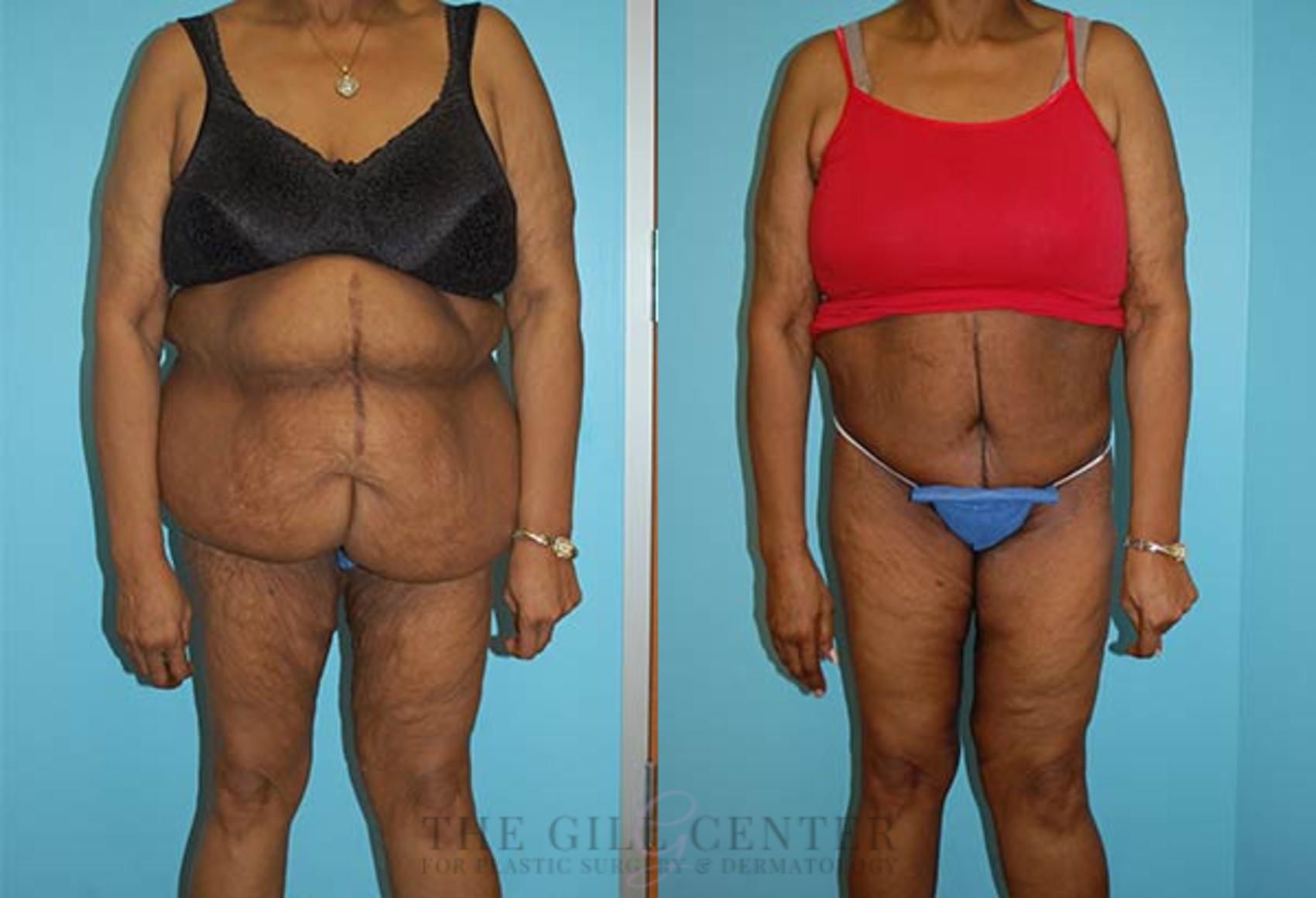 Body Lift Case 343 Before & After Front | The Woodlands, TX | The Gill Center for Plastic Surgery and Dermatology