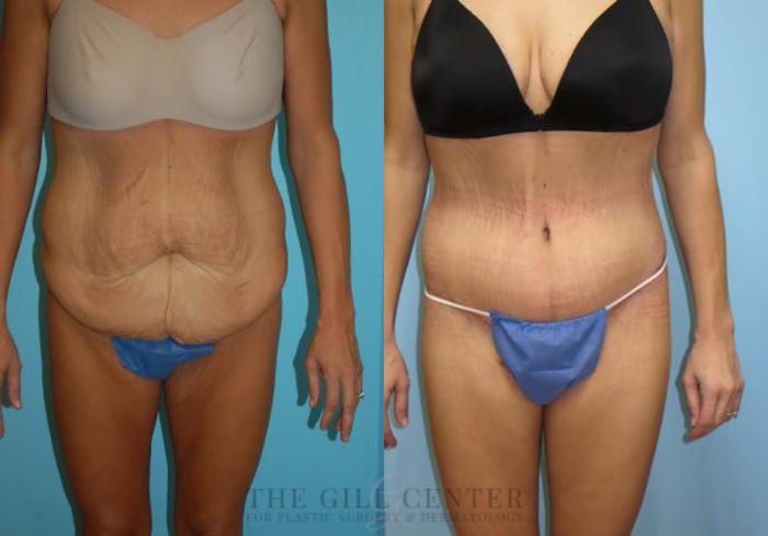 Body Lift Case 344 Before & After Front | The Woodlands, TX | The Gill Center for Plastic Surgery and Dermatology