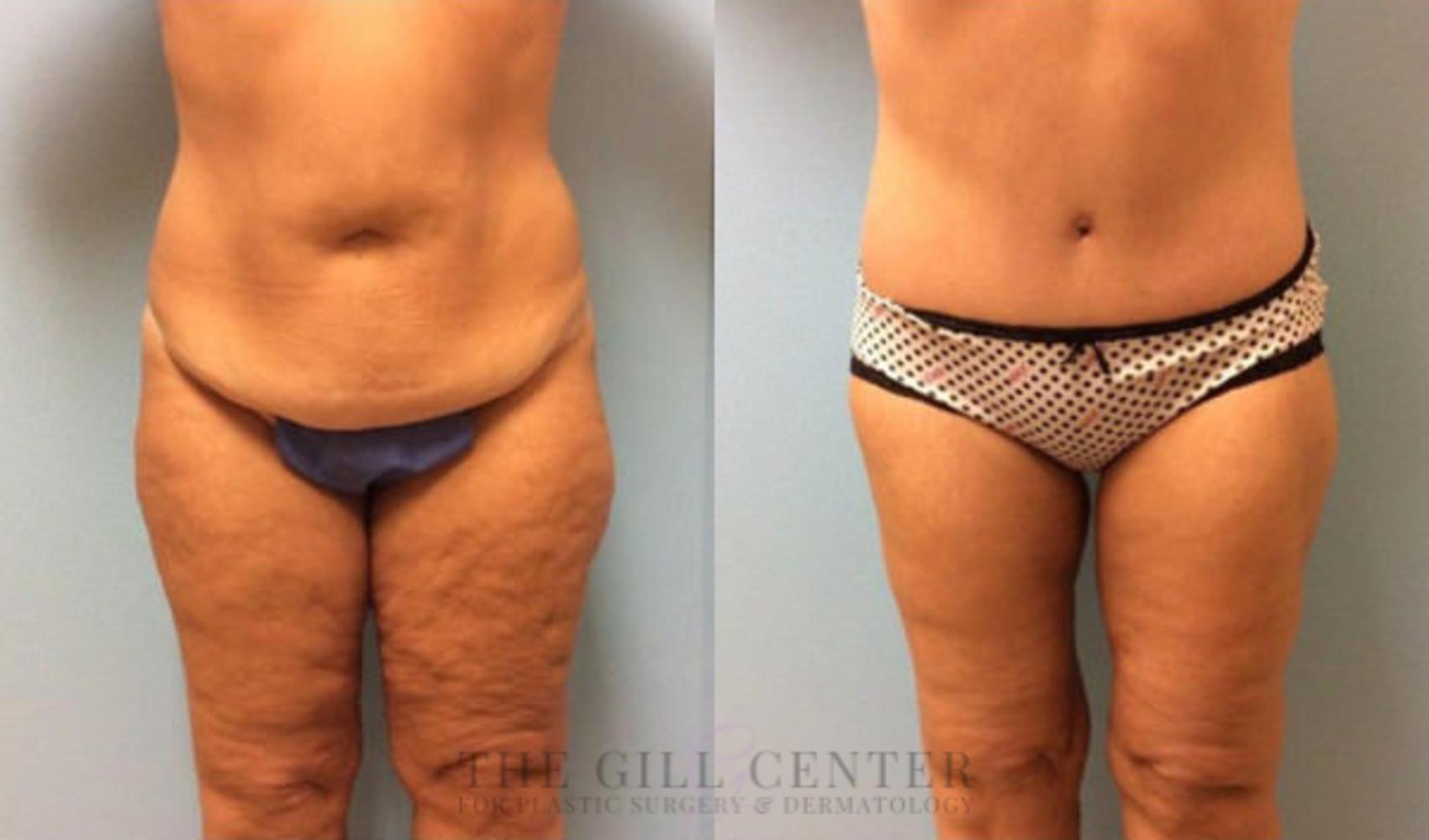 Body Lift Case 345 Before & After Front | The Woodlands, TX | The Gill Center for Plastic Surgery and Dermatology