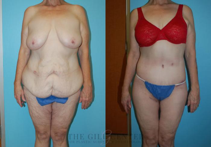 Body Lift Case 346 Before & After Front | The Woodlands, TX | The Gill Center for Plastic Surgery and Dermatology