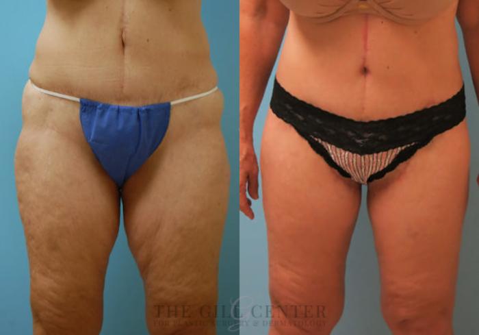 Body Lift Case 347 Before & After Front | The Woodlands, TX | The Gill Center for Plastic Surgery and Dermatology