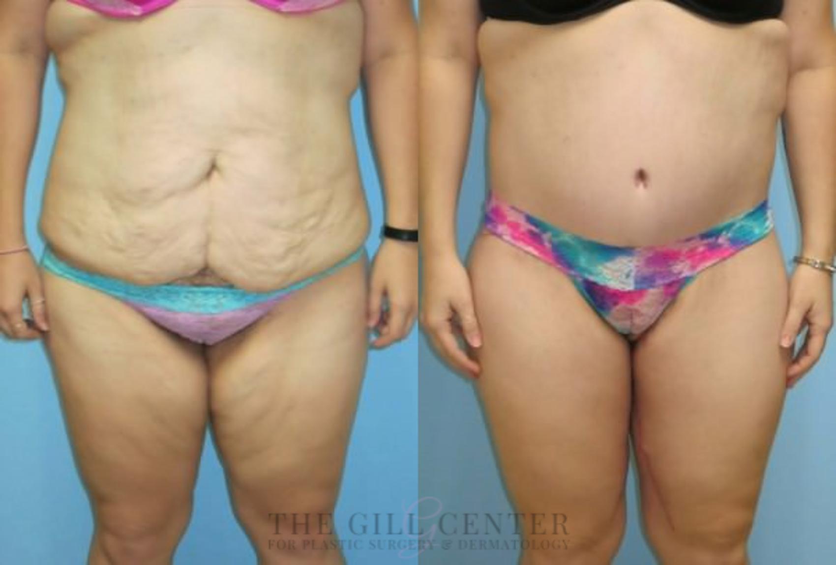 Body Lift Case 348 Before & After Front | The Woodlands, TX | The Gill Center for Plastic Surgery and Dermatology