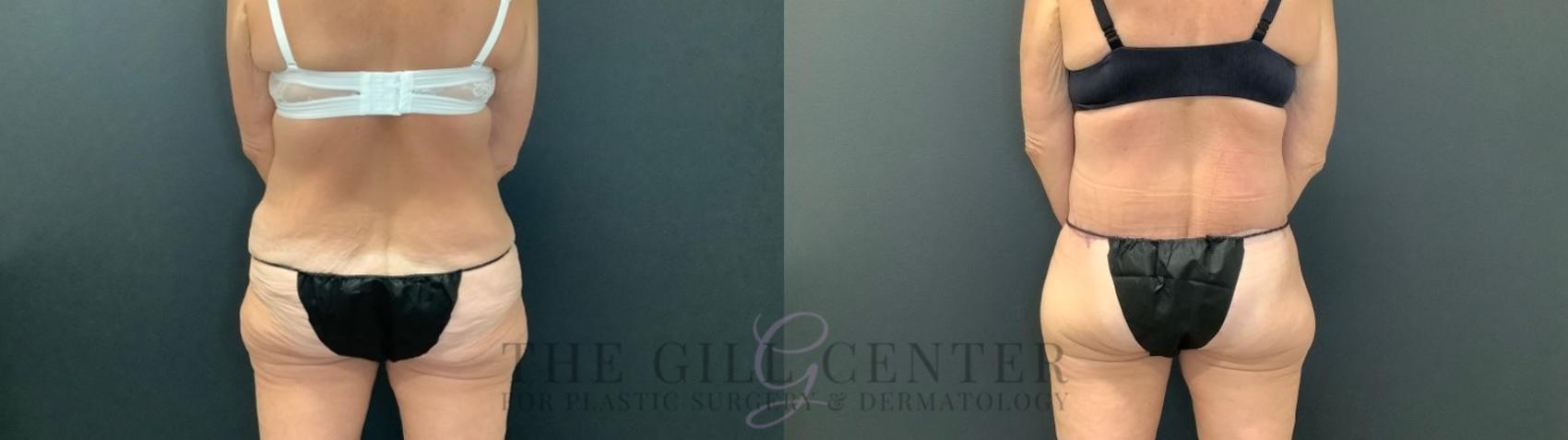 Body Lift Case 480 Before & After Back | The Woodlands, TX | The Gill Center for Plastic Surgery and Dermatology