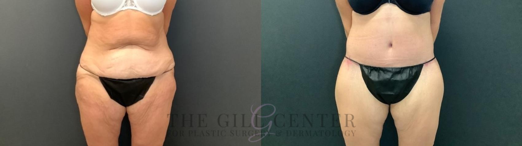 Body Lift Case 480 Before & After Front | The Woodlands, TX | The Gill Center for Plastic Surgery and Dermatology