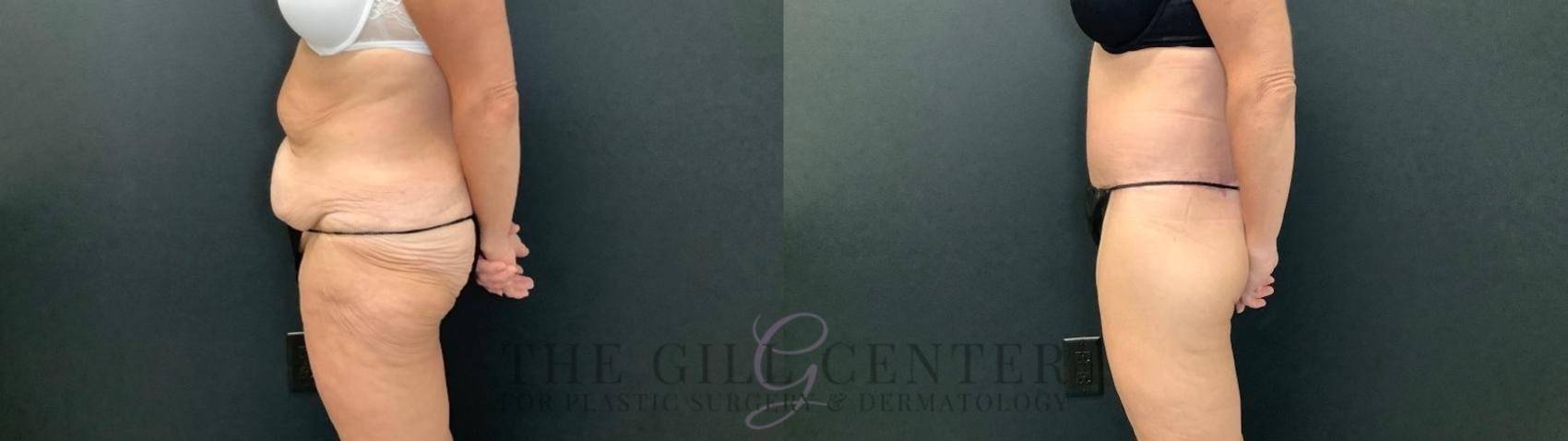 Body Lift Case 480 Before & After Left Side | The Woodlands, TX | The Gill Center for Plastic Surgery and Dermatology