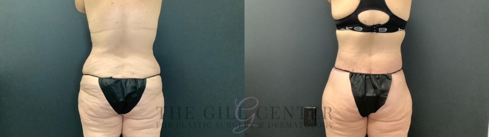 Body Lift Case 504 Before & After Back | The Woodlands, TX | The Gill Center for Plastic Surgery and Dermatology