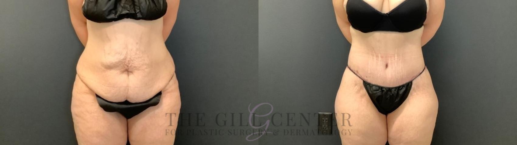 Body Lift Case 504 Before & After Front | The Woodlands, TX | The Gill Center for Plastic Surgery and Dermatology