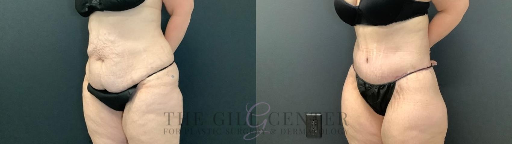 Body Lift Case 504 Before & After Left Oblique | The Woodlands, TX | The Gill Center for Plastic Surgery and Dermatology