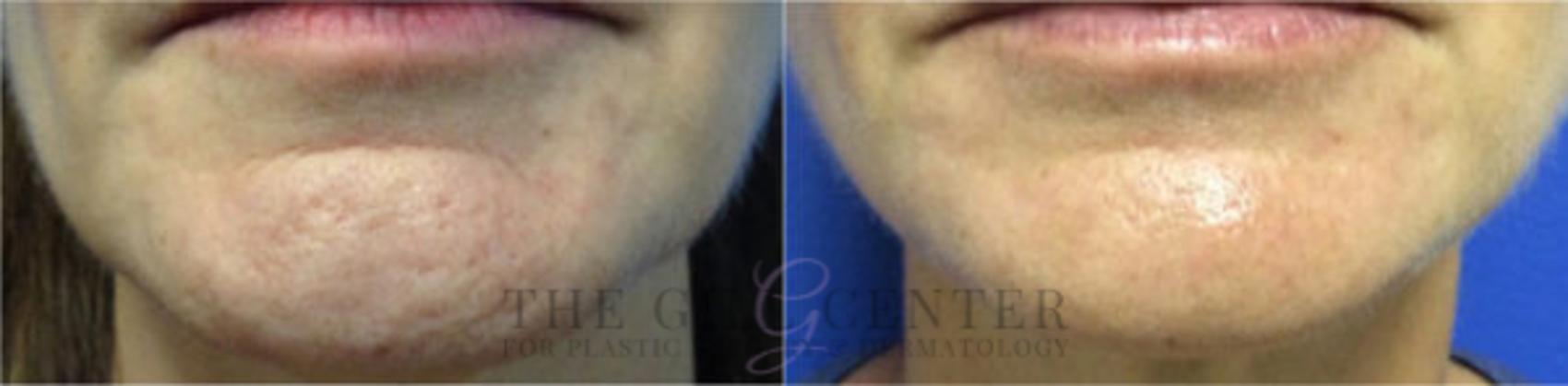 BOTOX® Cosmetic Case 17 Before & After Front | The Woodlands, TX | The Gill Center for Plastic Surgery and Dermatology