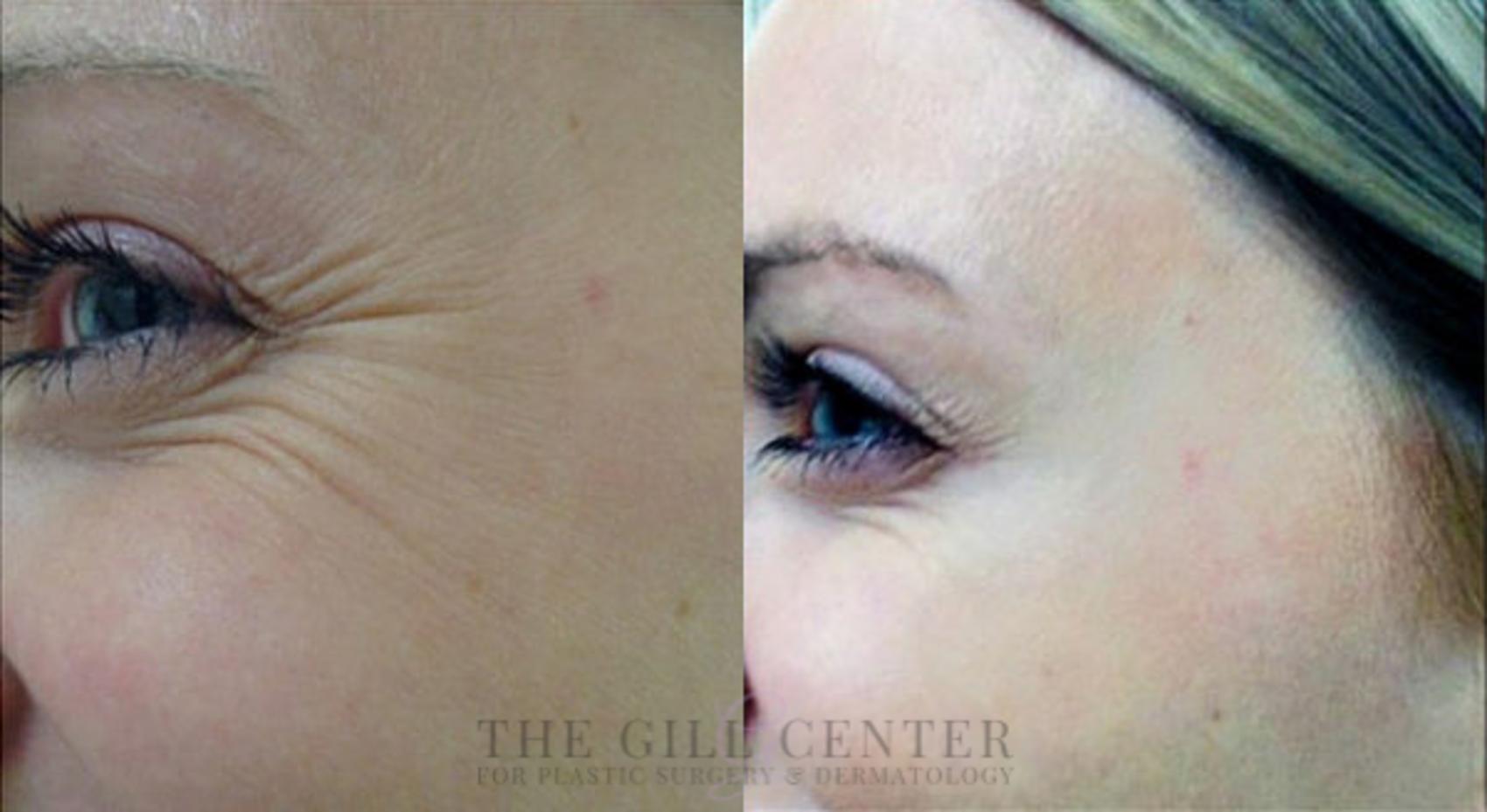 BOTOX® Cosmetic Case 19 Before & After Left Side | The Woodlands, TX | The Gill Center for Plastic Surgery and Dermatology
