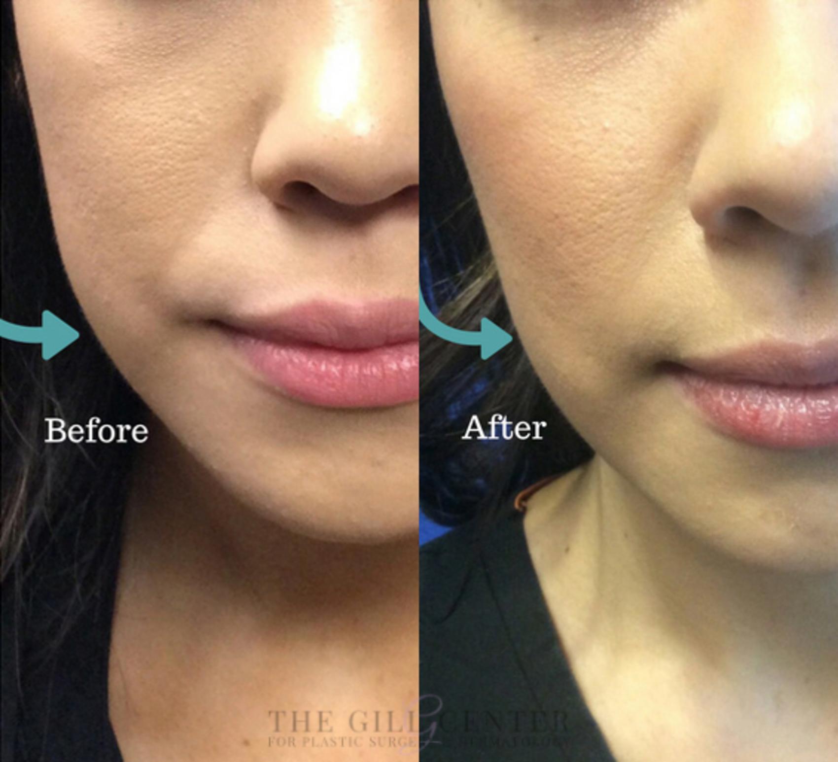 BOTOX® Cosmetic Case 20 Before & After Front | The Woodlands, TX | The Gill Center for Plastic Surgery and Dermatology