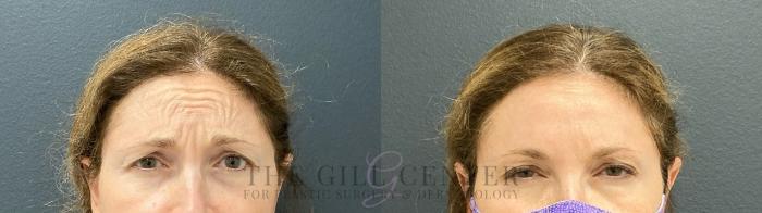 BOTOX® Cosmetic Case 478 Before & After Front | The Woodlands, TX | The Gill Center for Plastic Surgery and Dermatology