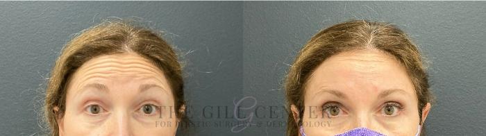 BOTOX® Cosmetic Case 479 Before & After Front | The Woodlands, TX | The Gill Center for Plastic Surgery and Dermatology