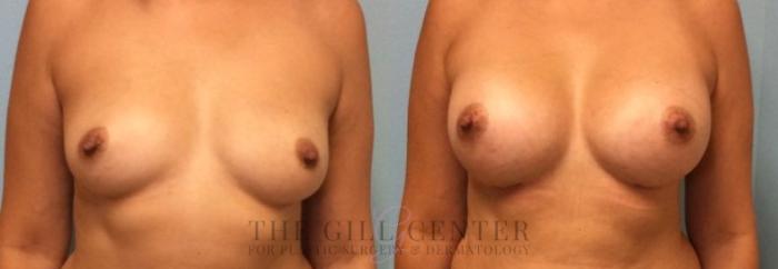 Breast Augmentation Case 21 Before & After Front | The Woodlands, TX | The Gill Center for Plastic Surgery and Dermatology
