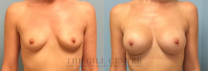 Breast Augmentation Case 22 Before & After Front | The Woodlands, TX | The Gill Center for Plastic Surgery and Dermatology