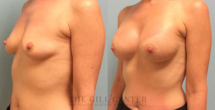 Breast Augmentation Case 24 Before & After Left Oblique | The Woodlands, TX | The Gill Center for Plastic Surgery and Dermatology