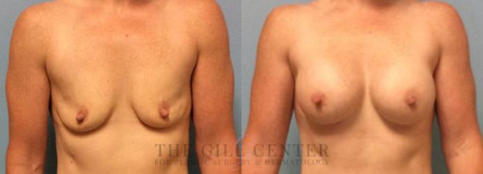 Breast Augmentation Case 25 Before & After Front | The Woodlands, TX | The Gill Center for Plastic Surgery and Dermatology