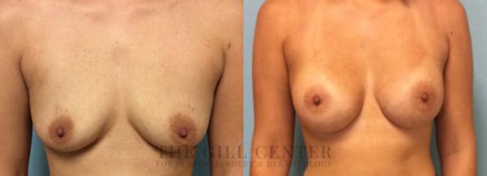 Breast Augmentation Case 26 Before & After Front | The Woodlands, TX | The Gill Center for Plastic Surgery and Dermatology