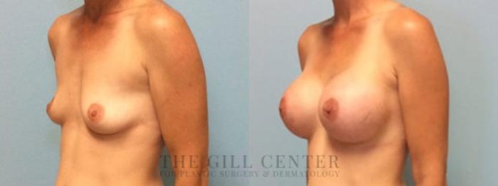 Breast Augmentation Case 27 Before & After Left Oblique | The Woodlands, TX | The Gill Center for Plastic Surgery and Dermatology