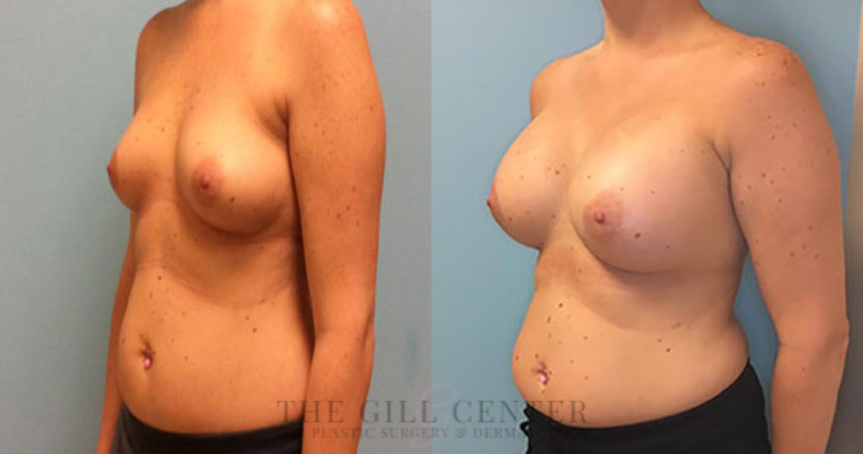 Breast Augmentation Case 28 Before & After Left Oblique | The Woodlands, TX | The Gill Center for Plastic Surgery and Dermatology