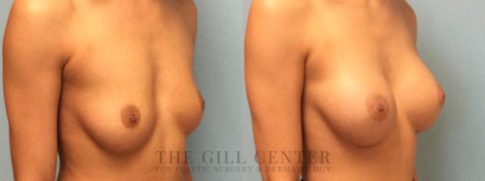 Breast Augmentation Case 29 Before & After Right Oblique | The Woodlands, TX | The Gill Center for Plastic Surgery and Dermatology