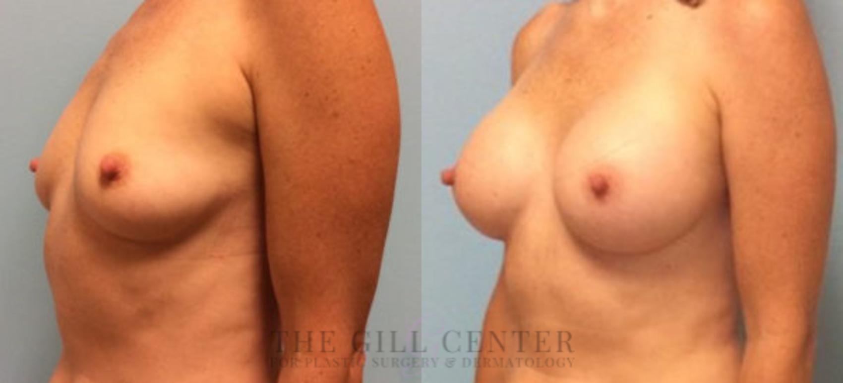 Breast Augmentation Case 31 Before & After Left Oblique | The Woodlands, TX | The Gill Center for Plastic Surgery and Dermatology