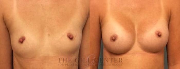 Breast Augmentation Case 34 Before & After Front | The Woodlands, TX | The Gill Center for Plastic Surgery and Dermatology