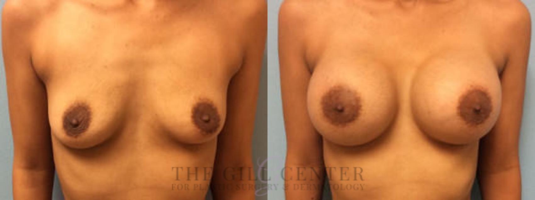 Breast Augmentation Case 35 Before & After Front | The Woodlands, TX | The Gill Center for Plastic Surgery and Dermatology