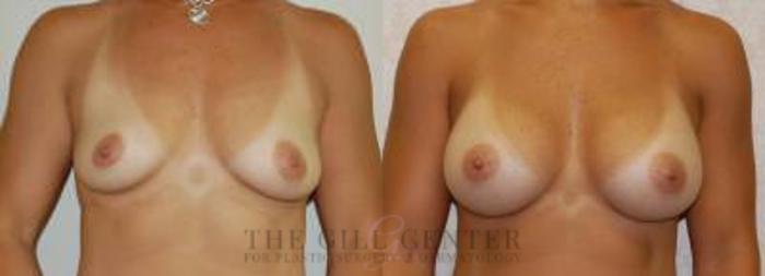 Breast Augmentation Case 36 Before & After Front | The Woodlands, TX | The Gill Center for Plastic Surgery and Dermatology