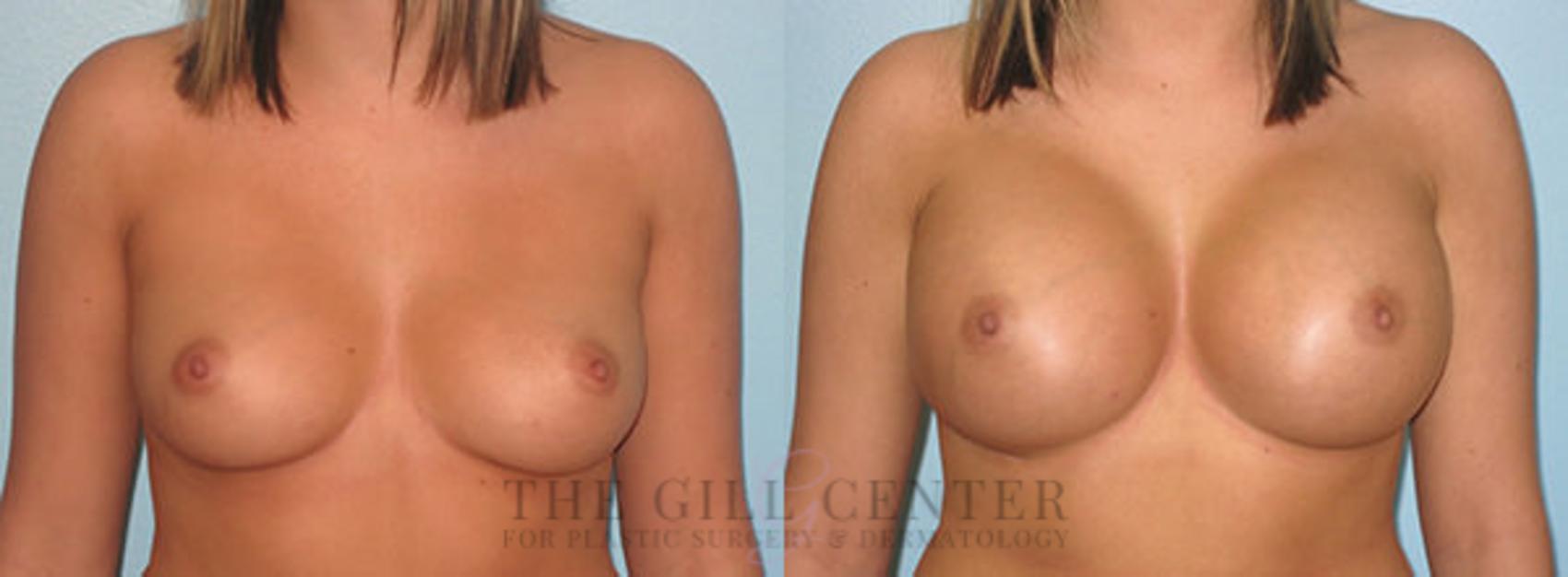 Breast Augmentation Case 38 Before & After Front | The Woodlands, TX | The Gill Center for Plastic Surgery and Dermatology