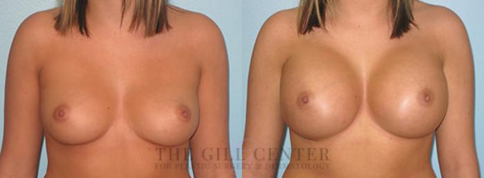 Breast Augmentation Case 38 Before & After Front | The Woodlands, TX | The Gill Center for Plastic Surgery and Dermatology