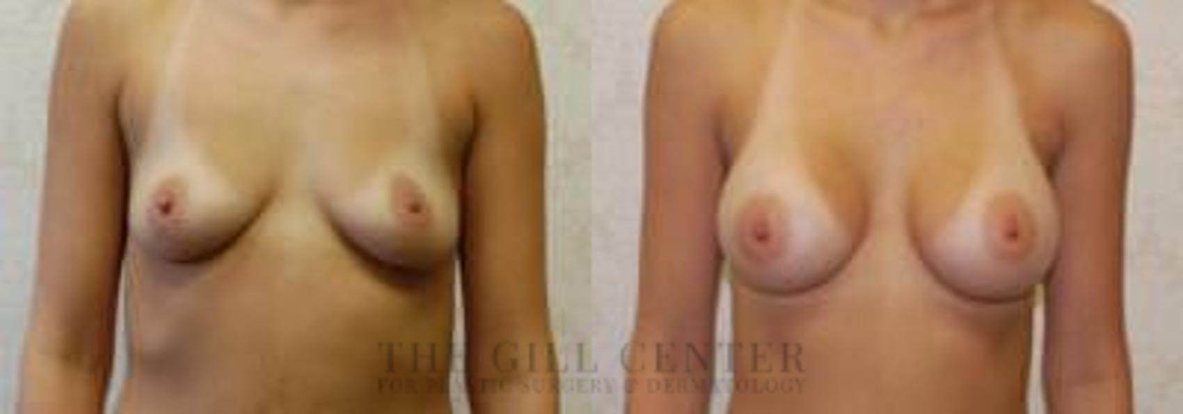 Breast Augmentation Case 39 Before & After Front | The Woodlands, TX | The Gill Center for Plastic Surgery and Dermatology