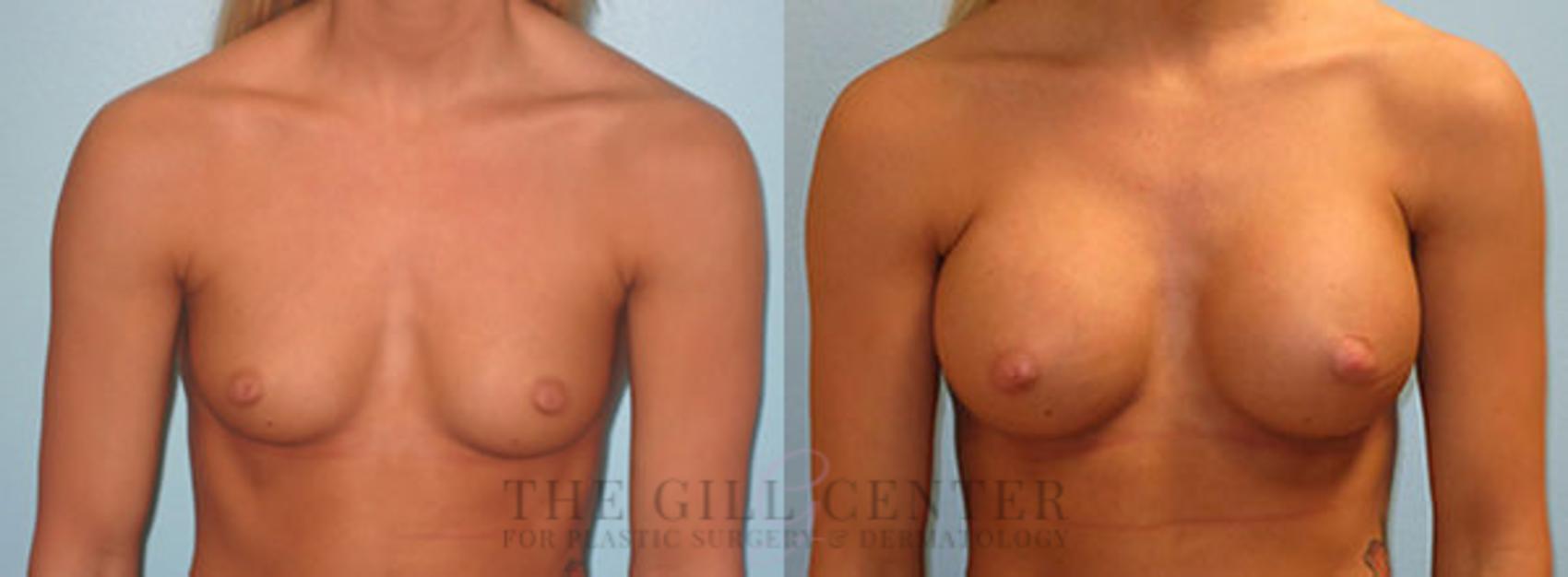 Breast Augmentation Case 40 Before & After Front | The Woodlands, TX | The Gill Center for Plastic Surgery and Dermatology
