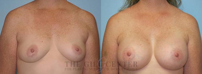 Breast Augmentation Case 41 Before & After Front | The Woodlands, TX | The Gill Center for Plastic Surgery and Dermatology