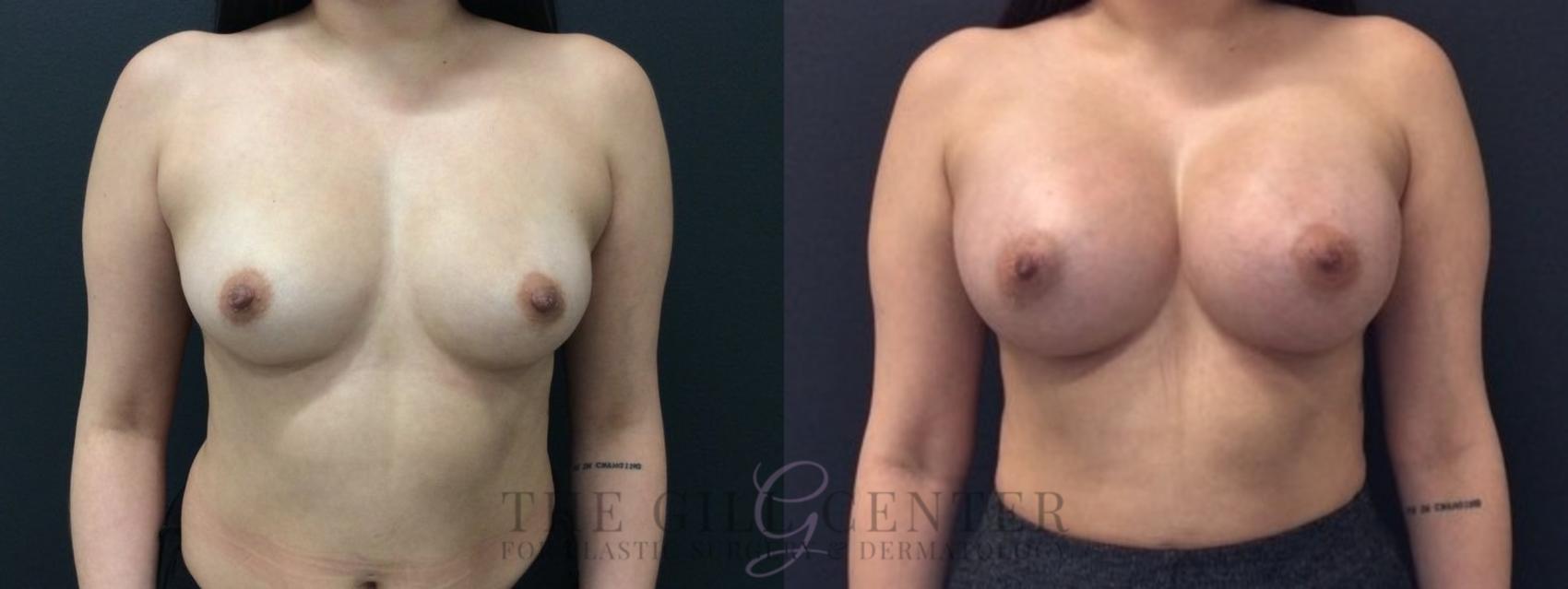 Breast Augmentation Case 421 Before & After Front | The Woodlands, TX | The Gill Center for Plastic Surgery and Dermatology