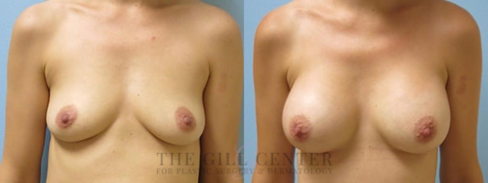 Breast Augmentation Case 428 Before & After Front | The Woodlands, TX | The Gill Center for Plastic Surgery and Dermatology