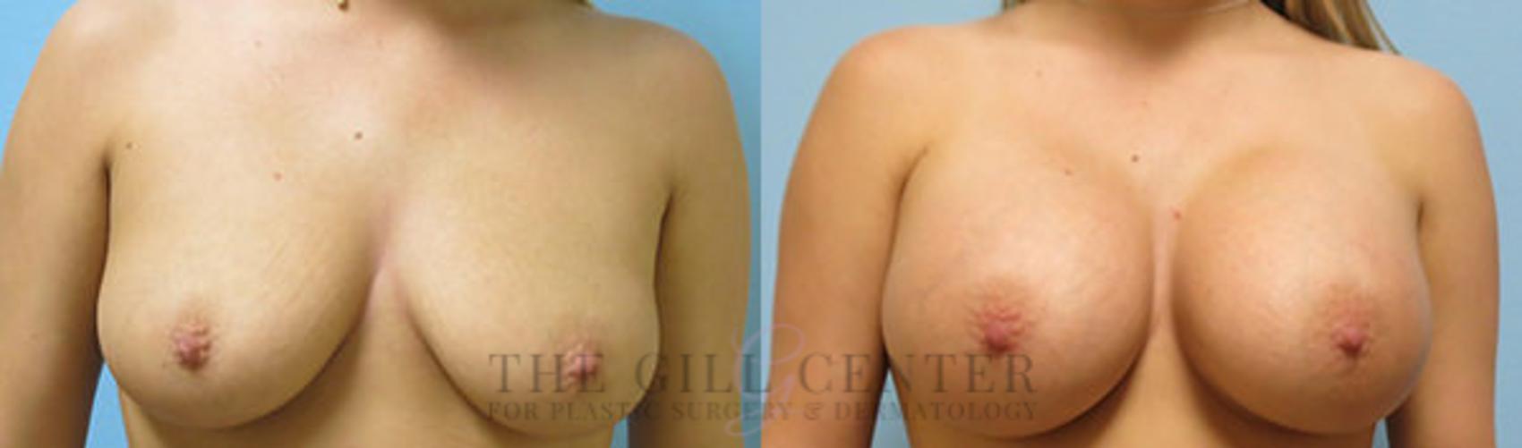 Breast Augmentation Case 43 Before & After Front | The Woodlands, TX | The Gill Center for Plastic Surgery and Dermatology