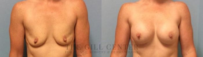 Breast Augmentation Case 431 Before & After Front | The Woodlands, TX | The Gill Center for Plastic Surgery and Dermatology