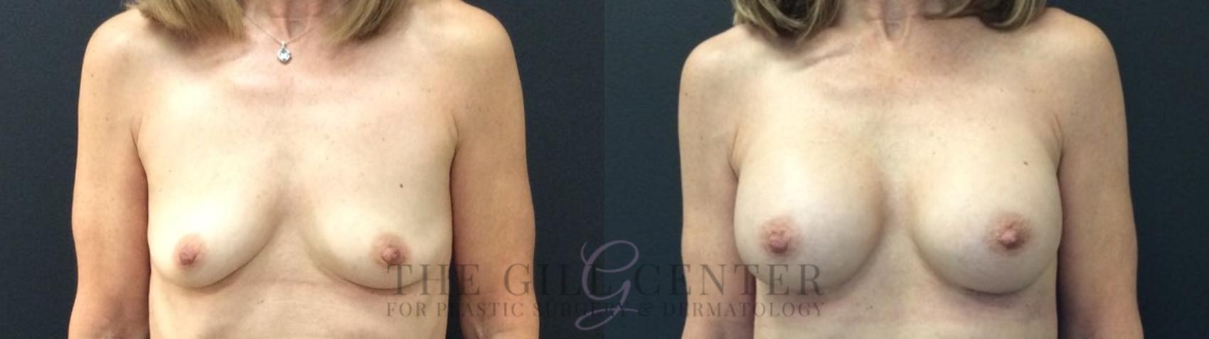 Breast Augmentation Case 433 Before & After Front | The Woodlands, TX | The Gill Center for Plastic Surgery and Dermatology