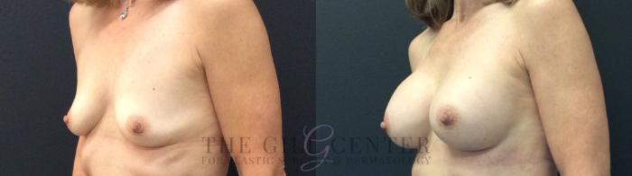 Breast Augmentation Case 433 Before & After Left Side | The Woodlands, TX | The Gill Center for Plastic Surgery and Dermatology