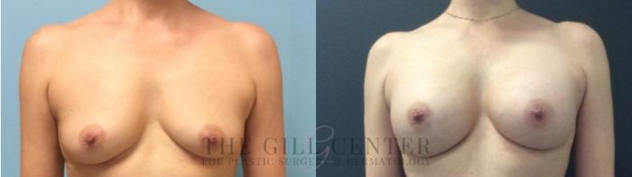 Breast Augmentation Case 437 Before & After Front | The Woodlands, TX | The Gill Center for Plastic Surgery and Dermatology